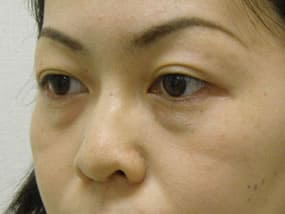 目の下のクマ・タルミ症例手術前