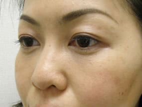 目の下のクマ・タルミ症例手術３ヶ月後