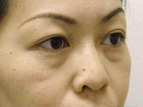 目の下のクマ・タルミ症例手術前