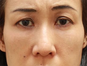 目の下のクマ・タルミ症例手術２ヶ月後