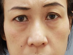 目の下のクマ・タルミ症例手術前（メイクあり）