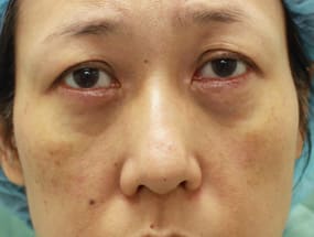 目の下のクマ・タルミ症例手術直後（メイクなし）