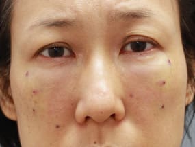 目の下のクマ・タルミ症例手術２日後（メイクあり）