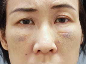 目の下のクマ・タルミ症例手術１週間後（メイクあり）