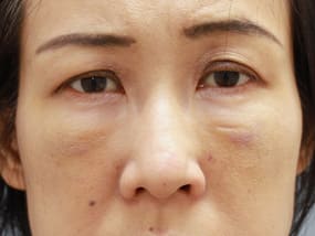 目の下のクマ・タルミ症例手術２週間後（メイクあり）