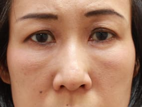 目の下のクマ・タルミ症例手術１ヵ月後（メイクあり）