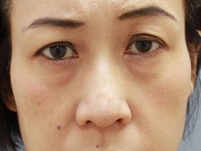 目の下のクマ・タルミ症例手術前