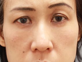 目の下のクマ・タルミ症例手術３ヶ月後