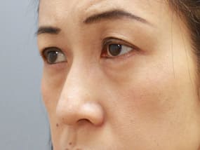 目の下のクマ・タルミ症例手術前