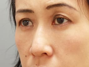 目の下のクマ・タルミ症例手術３ヶ月後