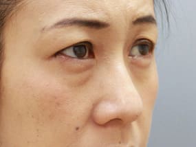 目の下のクマ・タルミ症例手術前