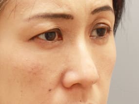 目の下のクマ・タルミ症例手術３ヶ月後