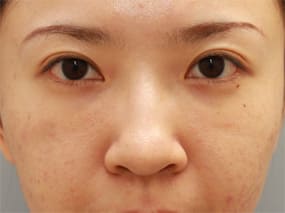 目の下のクマ・タルミ症例手術２ヶ月後
