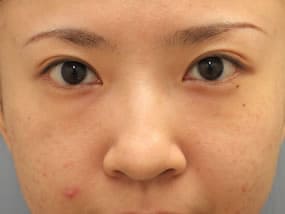目の下のクマ・タルミ症例手術前（メイクあり）