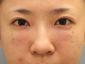目の下のクマ・タルミ症例手術直後（メイクなし）