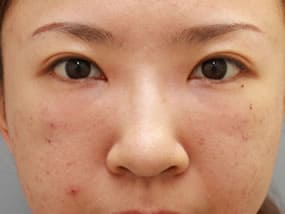 目の下のクマ・タルミ症例手術２日後（メイクあり）
