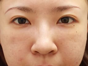 目の下のクマ・タルミ症例手術１週間後（メイクあり）
