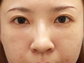 目の下のクマ・タルミ症例手術２週間後（メイクあり）