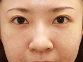 目の下のクマ・タルミ症例手術１ヵ月後（メイクあり）