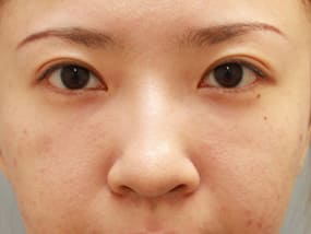 目の下のクマ・タルミ症例手術３ヶ月後