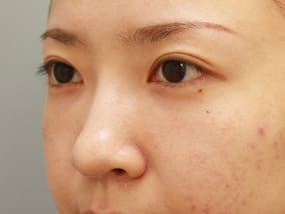 目の下のクマ・タルミ症例手術３ヶ月後