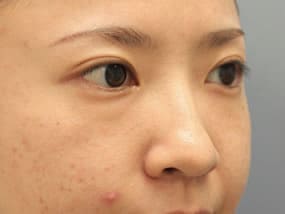 目の下のクマ・タルミ症例手術前
