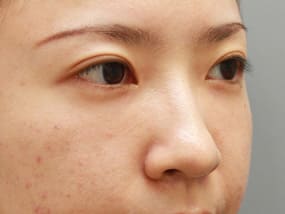 目の下のクマ・タルミ症例手術３ヶ月後