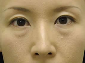 目の下のクマ・タルミ症例手術前（メイクあり）