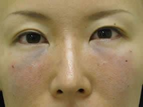 目の下のクマ・タルミ症例手術直後（メイクなし）