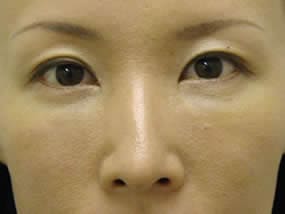 目の下のクマ・タルミ症例手術２日後（メイクあり）