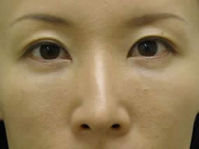 目の下のクマ・タルミ症例手術１週間後（メイクあり）