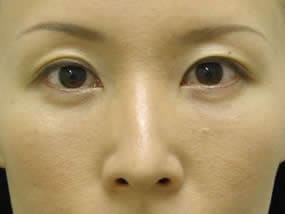 目の下のクマ・タルミ症例手術２週間後（メイクあり）