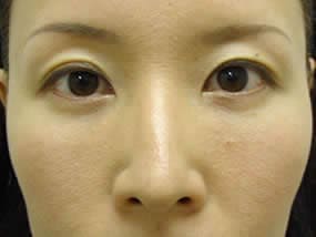 目の下のクマ・タルミ症例手術１ヵ月後（メイクあり）