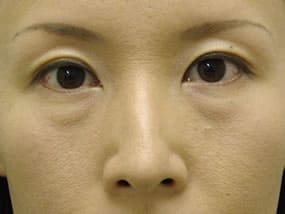 目の下のクマ・タルミ症例手術前