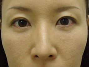 目の下のクマ・タルミ症例手術３ヶ月後
