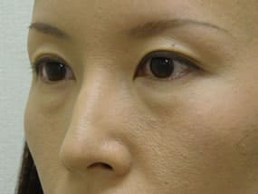 目の下のクマ・タルミ症例手術前