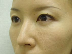 目の下のクマ・タルミ症例手術３ヶ月後
