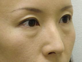 目の下のクマ・タルミ症例手術前