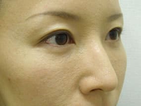 目の下のクマ・タルミ症例手術３ヶ月後