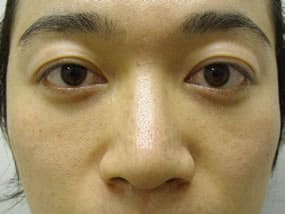 目の下のクマ・タルミ症例手術３ヶ月後