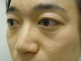 目の下のクマ・タルミ症例手術前