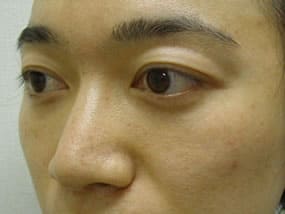 目の下のクマ・タルミ症例手術３ヶ月後