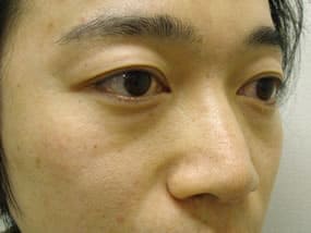 目の下のクマ・タルミ症例手術前