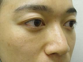 目の下のクマ・タルミ症例手術３ヶ月後