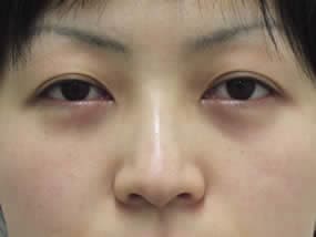 目の下のクマ・タルミ症例手術直後（メイクなし）
