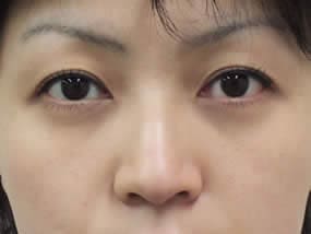 目の下のクマ・タルミ症例手術１週間後（メイクあり）