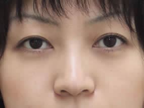 目の下のクマ・タルミ症例手術２週間後（メイクあり）