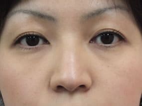 目の下のクマ・タルミ症例手術前