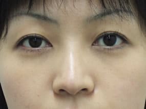 目の下のクマ・タルミ症例手術３ヶ月後