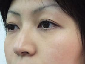 目の下のクマ・タルミ症例手術前